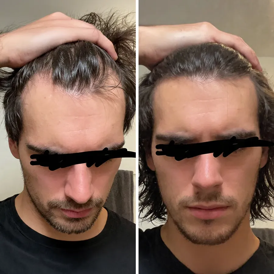 Avant après DHT Blocker homme, ligne frontale et golfes regarnis