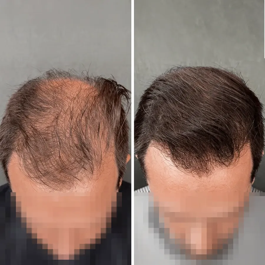 Avant après DHT Blocker homme, densité du sommet du crâne (vertex) restaurée